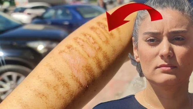 Epilasyon yaptıran kadın hayatının şokunu yaşadı! Kollarında yanık izleri oluştu
