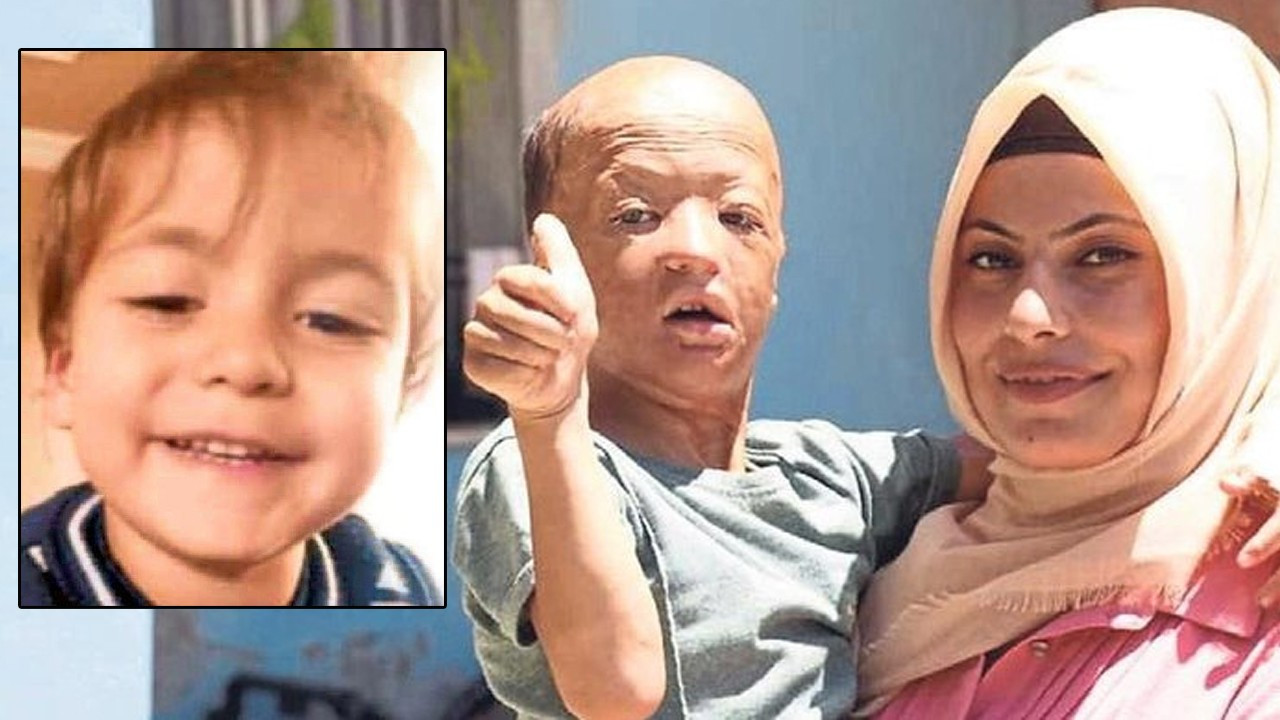 Yanan otomobilden kurtarılan minik Halil'e iki kez doku nakli yapıldı